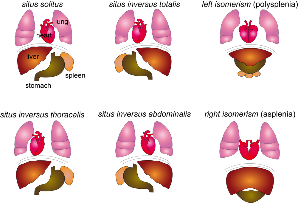 study-laterality-defects-including-heart-and-vascular-malformations